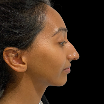 ethnic-rhinoplasty-before
